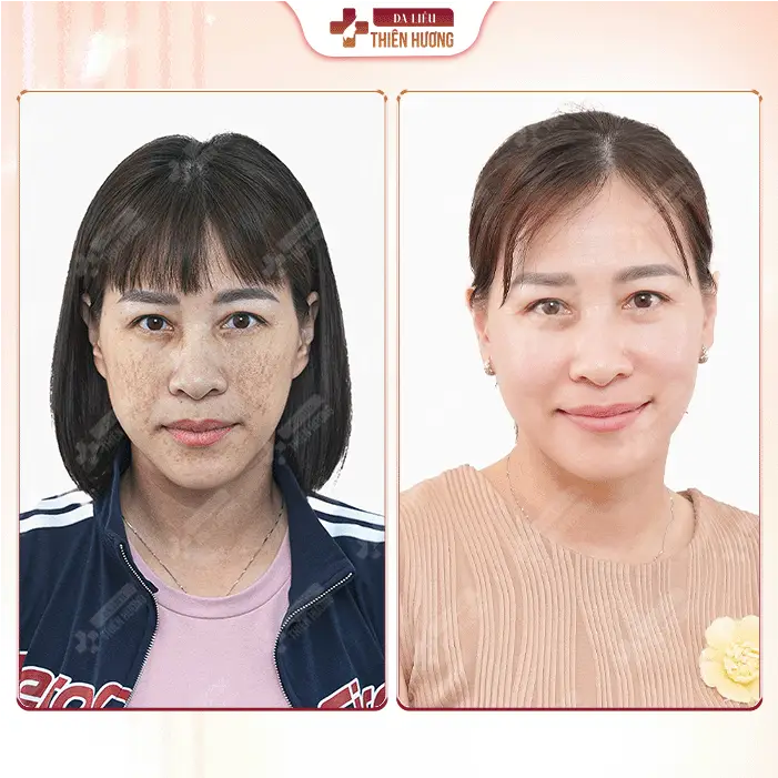 Phòng Khám Da Liễu Thiên Hương – Chuyên Điều Trị Nám Da