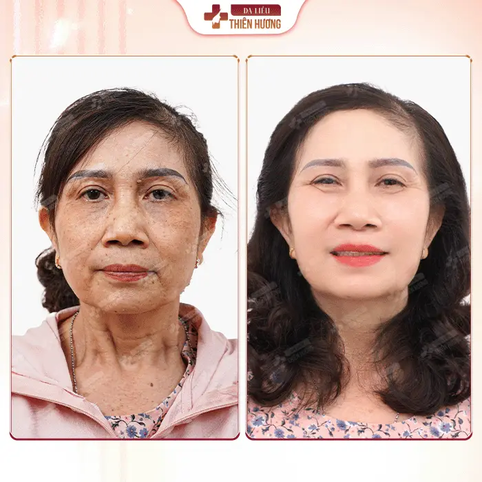 Phòng Khám Da Liễu Thiên Hương – Chuyên Điều Trị Nám Da