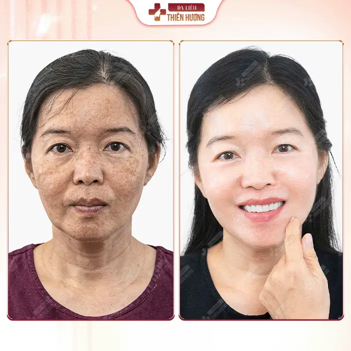 Phòng Khám Da Liễu Thiên Hương – Chuyên Điều Trị Nám Da