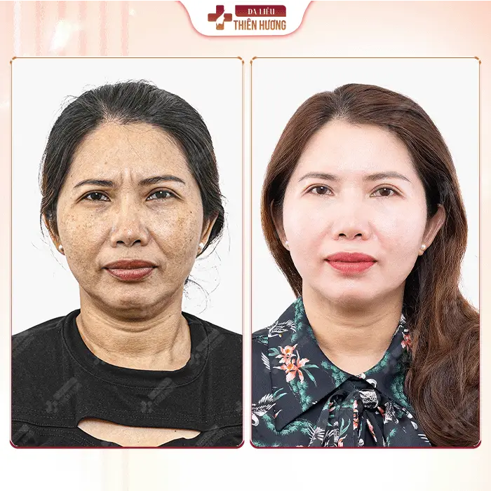 Phòng Khám Da Liễu Thiên Hương – Chuyên Điều Trị Nám Da