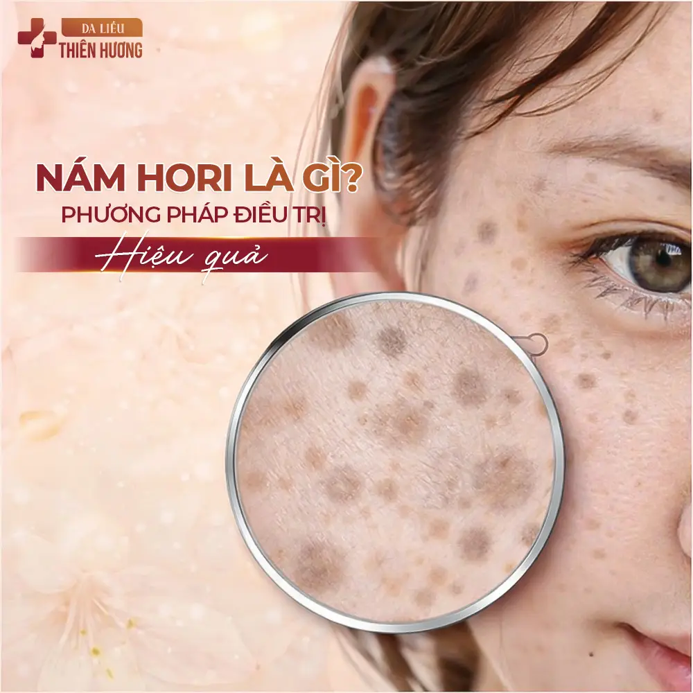 Nám Hori (Bớt Hori): Dấu Hiệu Nhận Biết, Nguyên Nhân & Cách Điều Trị