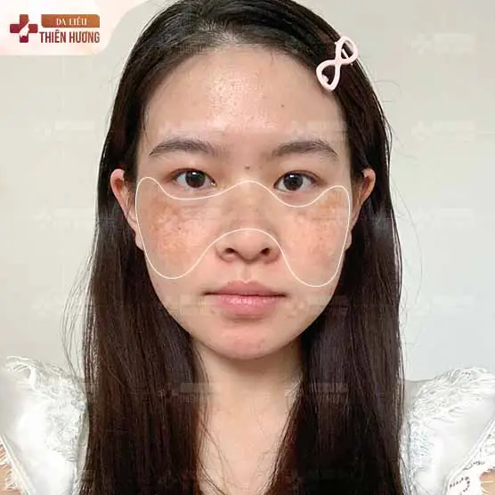 Nám Cánh Bướm Là Gì? Nguyên Nhân, Dấu Hiệu & Cách Điều Trị
