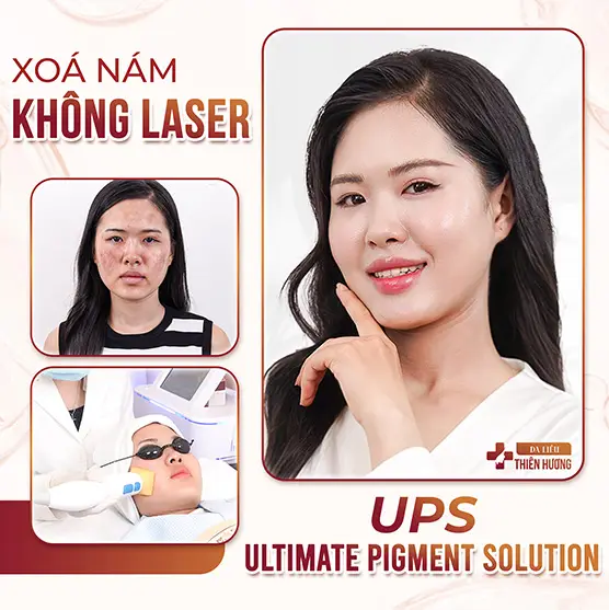 Nám Cánh Bướm Là Gì? Nguyên Nhân, Dấu Hiệu & Cách Điều Trị