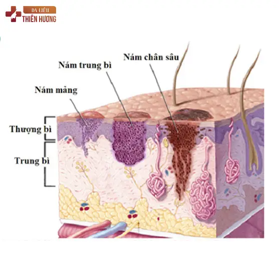 Nám Cánh Bướm Là Gì? Nguyên Nhân, Dấu Hiệu & Cách Điều Trị