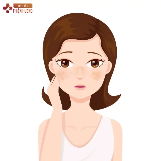 Nám Cánh Bướm Là Gì? Nguyên Nhân, Dấu Hiệu & Cách Điều Trị
