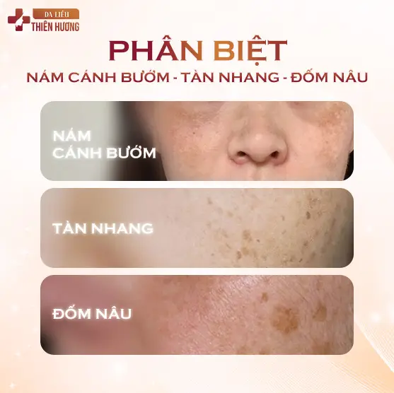 Nám Cánh Bướm Là Gì? Nguyên Nhân, Dấu Hiệu & Cách Điều Trị