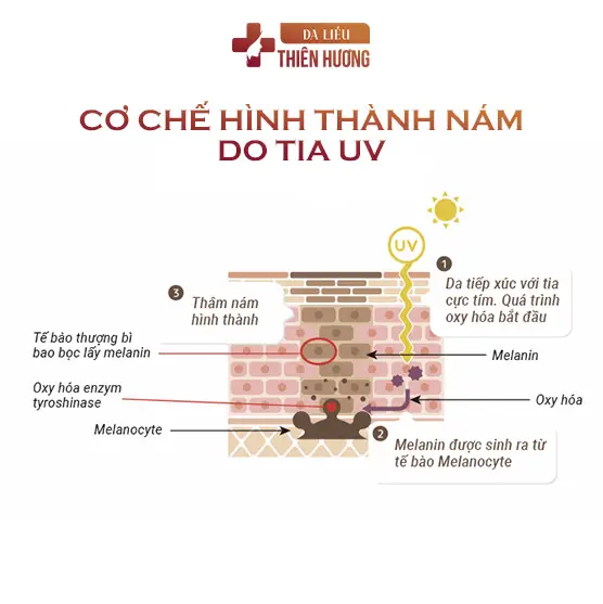 Nám Cánh Bướm Là Gì? Nguyên Nhân, Dấu Hiệu & Cách Điều Trị
