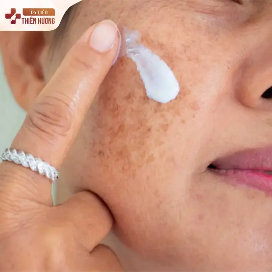 Nám Cánh Bướm Là Gì? Nguyên Nhân, Dấu Hiệu & Cách Điều Trị