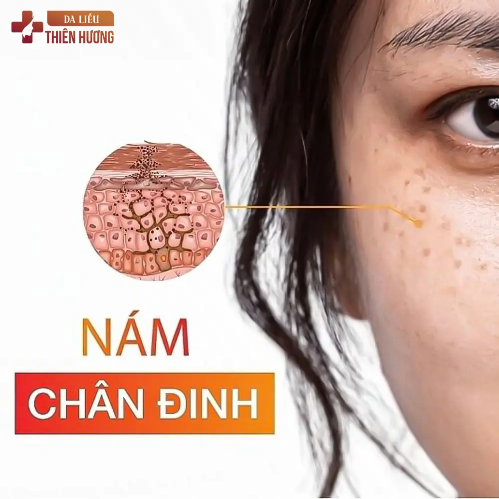 Nám Chân Đinh Là Gì? Nguyên Nhân, Dấu Hiệu & Cách Điều Trị