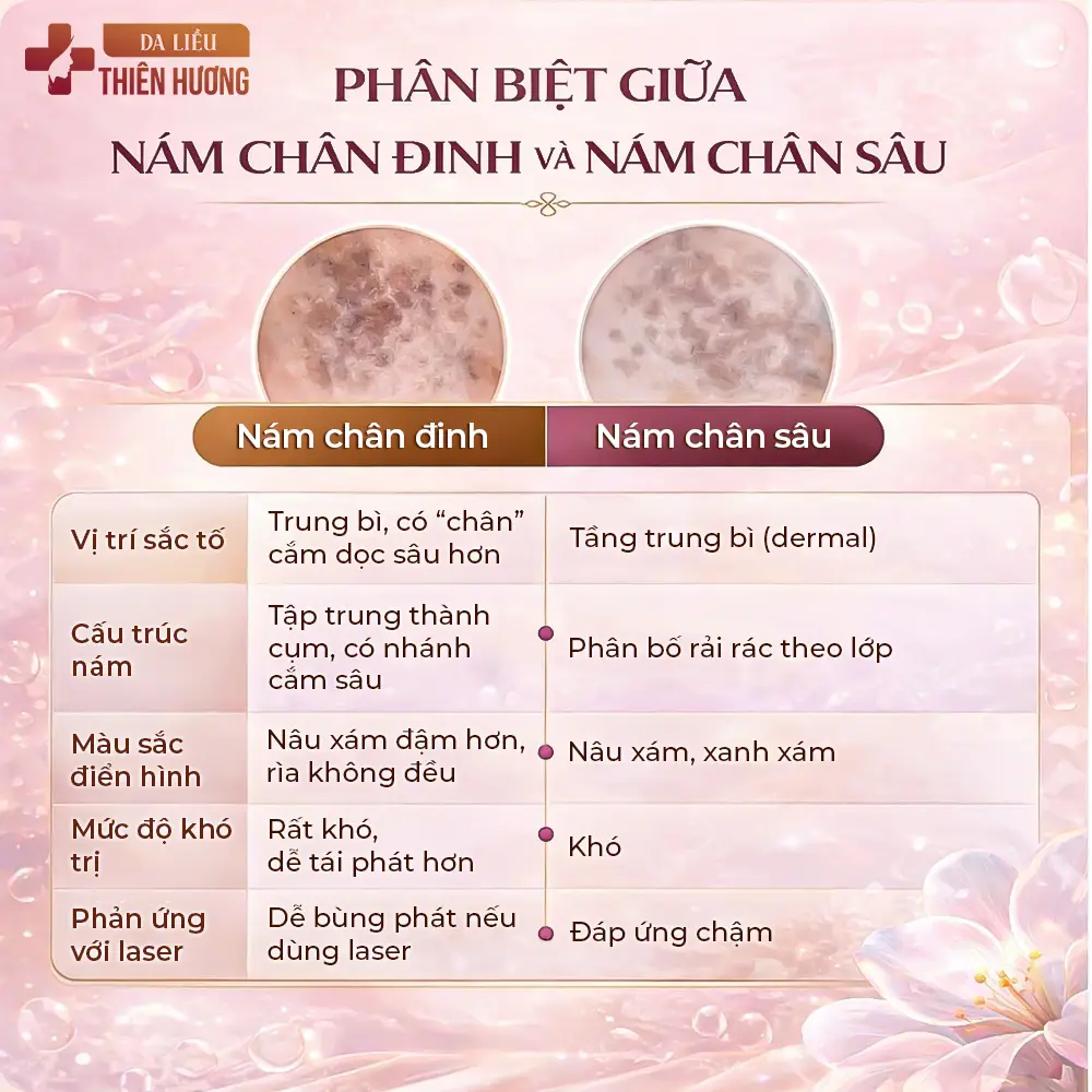 Nám Chân Đinh Là Gì? Nguyên Nhân, Dấu Hiệu & Cách Điều Trị