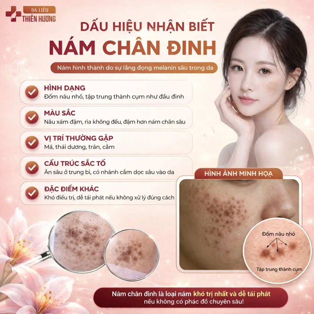 Nám Chân Đinh Là Gì? Nguyên Nhân, Dấu Hiệu & Cách Điều Trị