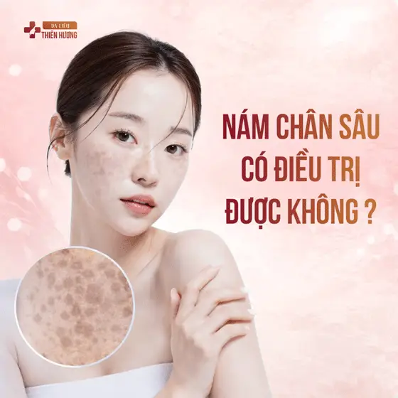 Nám Chân Sâu Là Gì? Nguyên Nhân, Dấu Hiệu & Cách Điều Trị