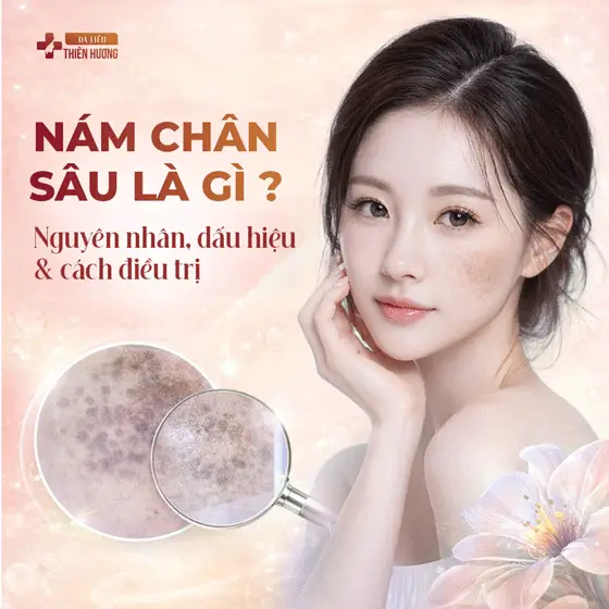 Nám Chân Sâu Là Gì? Nguyên Nhân, Dấu Hiệu & Cách Điều Trị