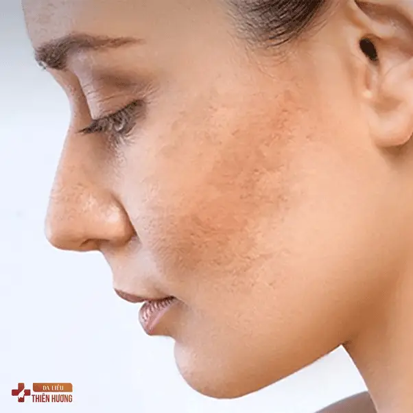 Nám Da: Nguyên Nhân, Phân Loại & Cách Điều Trị Hiệu Quả