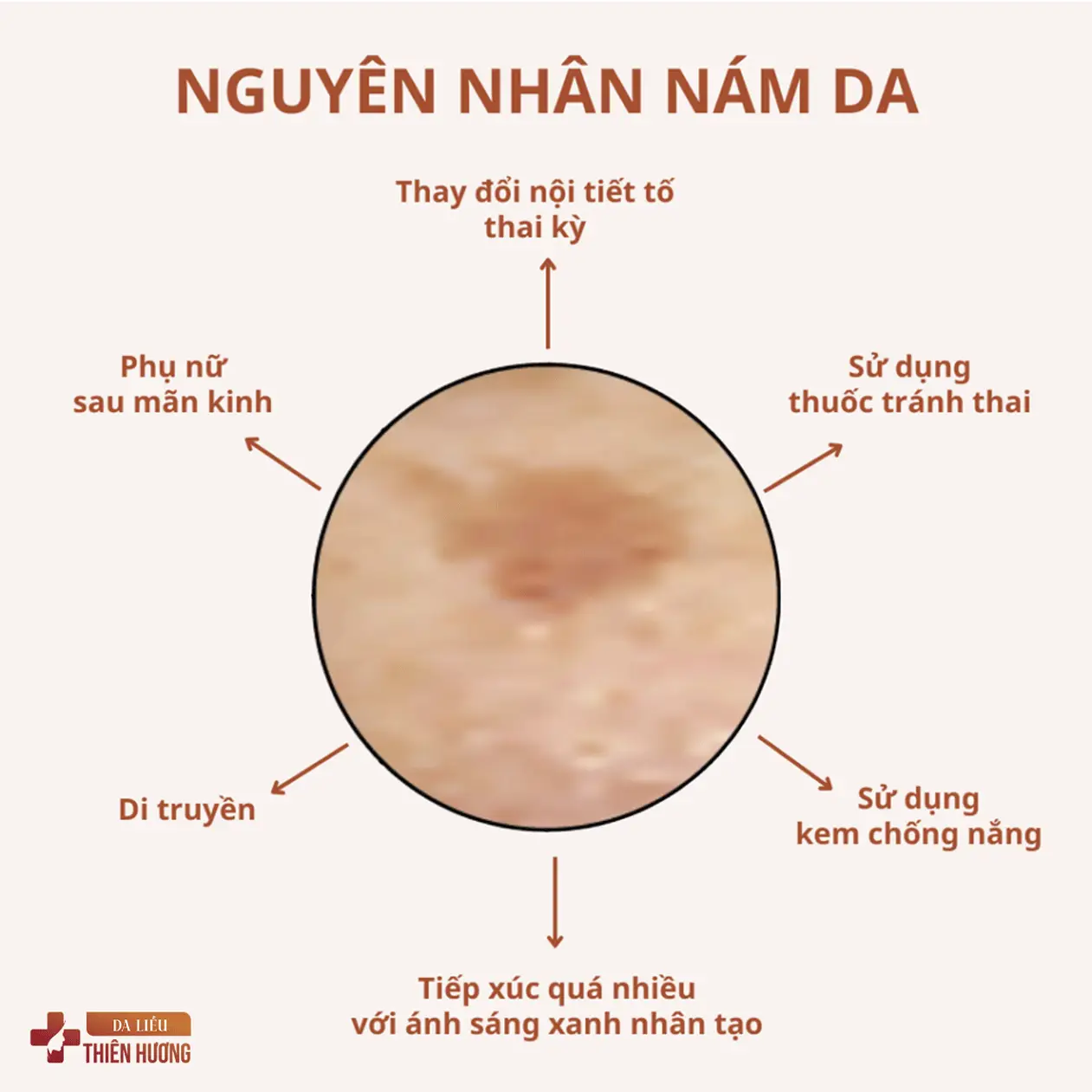 Nám Da: Nguyên Nhân, Phân Loại & Cách Điều Trị Hiệu Quả