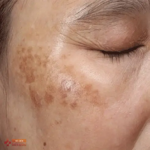 Nám Da: Nguyên Nhân, Phân Loại & Cách Điều Trị Hiệu Quả