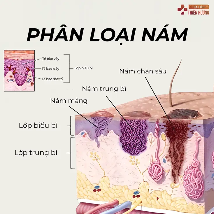 Nám Da: Nguyên Nhân, Phân Loại & Cách Điều Trị Hiệu Quả