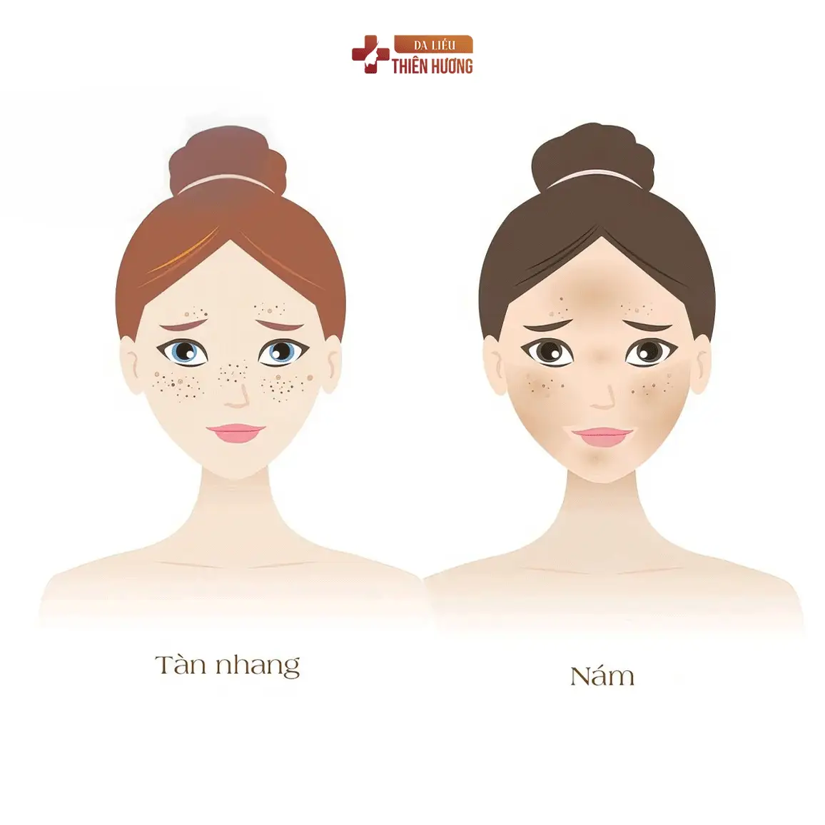 Nám Da: Nguyên Nhân, Phân Loại & Cách Điều Trị Hiệu Quả
