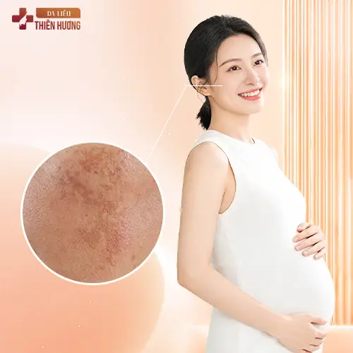 Nám Da Khi Mang Thai: Nguyên Nhân, Cách Phòng Ngừa & Điều Trị An Toàn