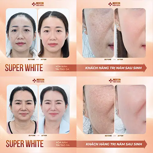 Nám Da Khi Mang Thai: Nguyên Nhân, Cách Phòng Ngừa & Điều Trị An Toàn