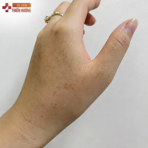 Nám Da Tay Là Gì? Nguyên Nhân & Cách Điều Trị Hiệu Quả