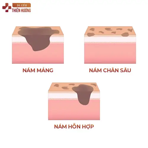 Nám Da Tay Là Gì? Nguyên Nhân & Cách Điều Trị Hiệu Quả