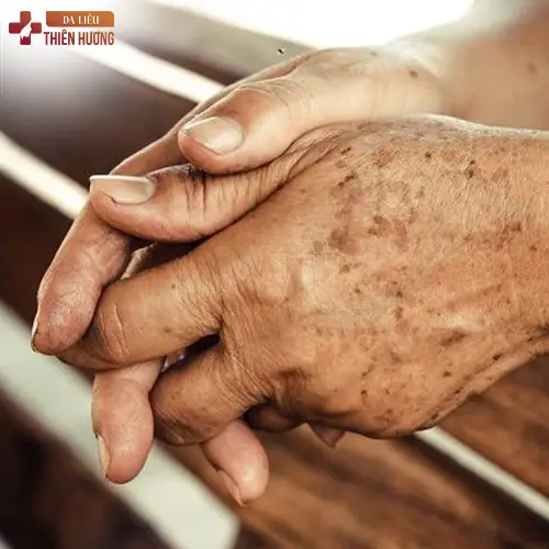 Nám Da Tay Là Gì? Nguyên Nhân & Cách Điều Trị Hiệu Quả