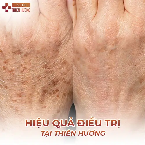 Nám Da Tay Là Gì? Nguyên Nhân & Cách Điều Trị Hiệu Quả