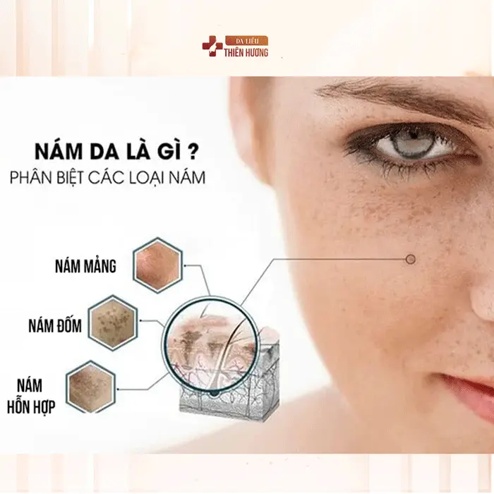 3 Loại Nám Da Phổ Biến: Đặc Điểm, Nguyên Nhân & Cách Nhận Biết