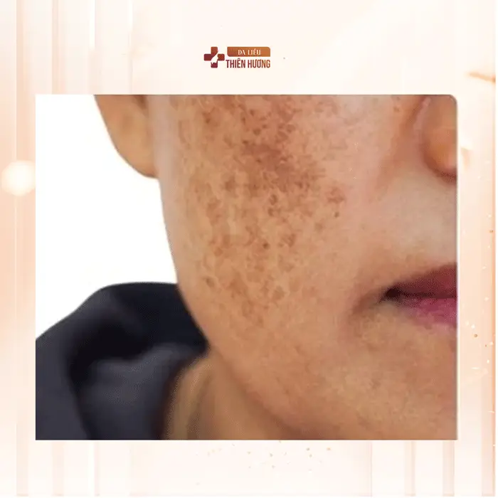 3 Loại Nám Da Phổ Biến: Đặc Điểm, Nguyên Nhân & Cách Nhận Biết