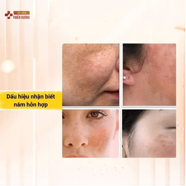 3 Loại Nám Da Phổ Biến: Đặc Điểm, Nguyên Nhân & Cách Nhận Biết
