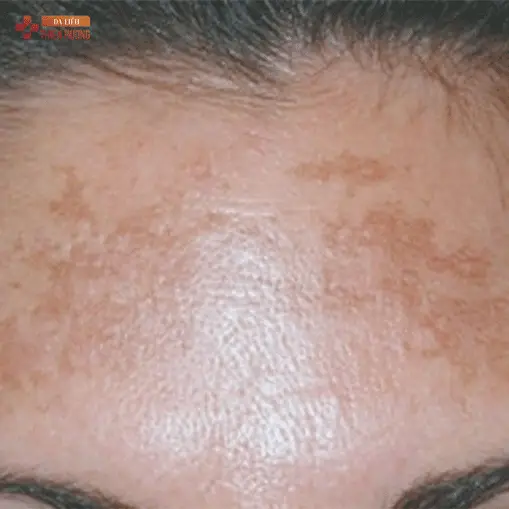 Nám Da Ở Trán: Nguyên Nhân, Dấu Hiệu & Cách Điều Trị