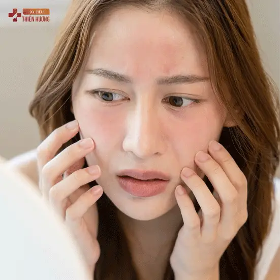 Nám Da Ở Trán: Nguyên Nhân, Dấu Hiệu & Cách Điều Trị