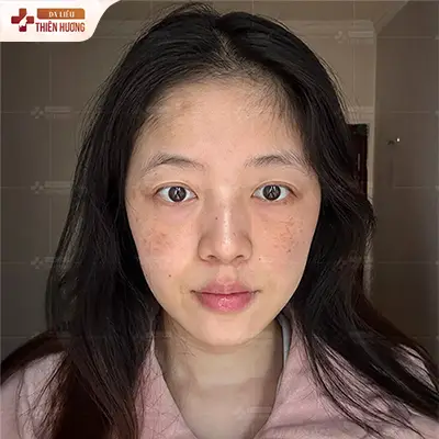 Nám Đốm Là Gì? Nguyên Nhân, Cách Nhận Biết & Điều Trị Dứt Điểm
