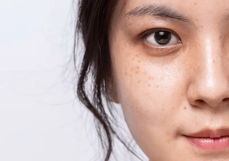 Nám Đốm Là Gì? Nguyên Nhân, Cách Nhận Biết & Điều Trị Dứt Điểm