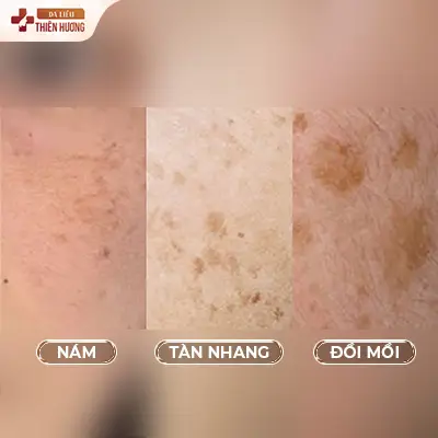Nám Đốm Là Gì? Nguyên Nhân, Cách Nhận Biết & Điều Trị Dứt Điểm