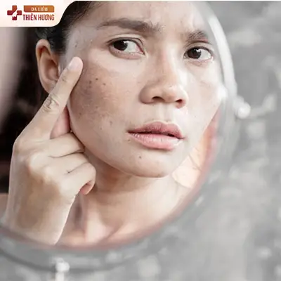 Nám Đốm Là Gì? Nguyên Nhân, Cách Nhận Biết & Điều Trị Dứt Điểm