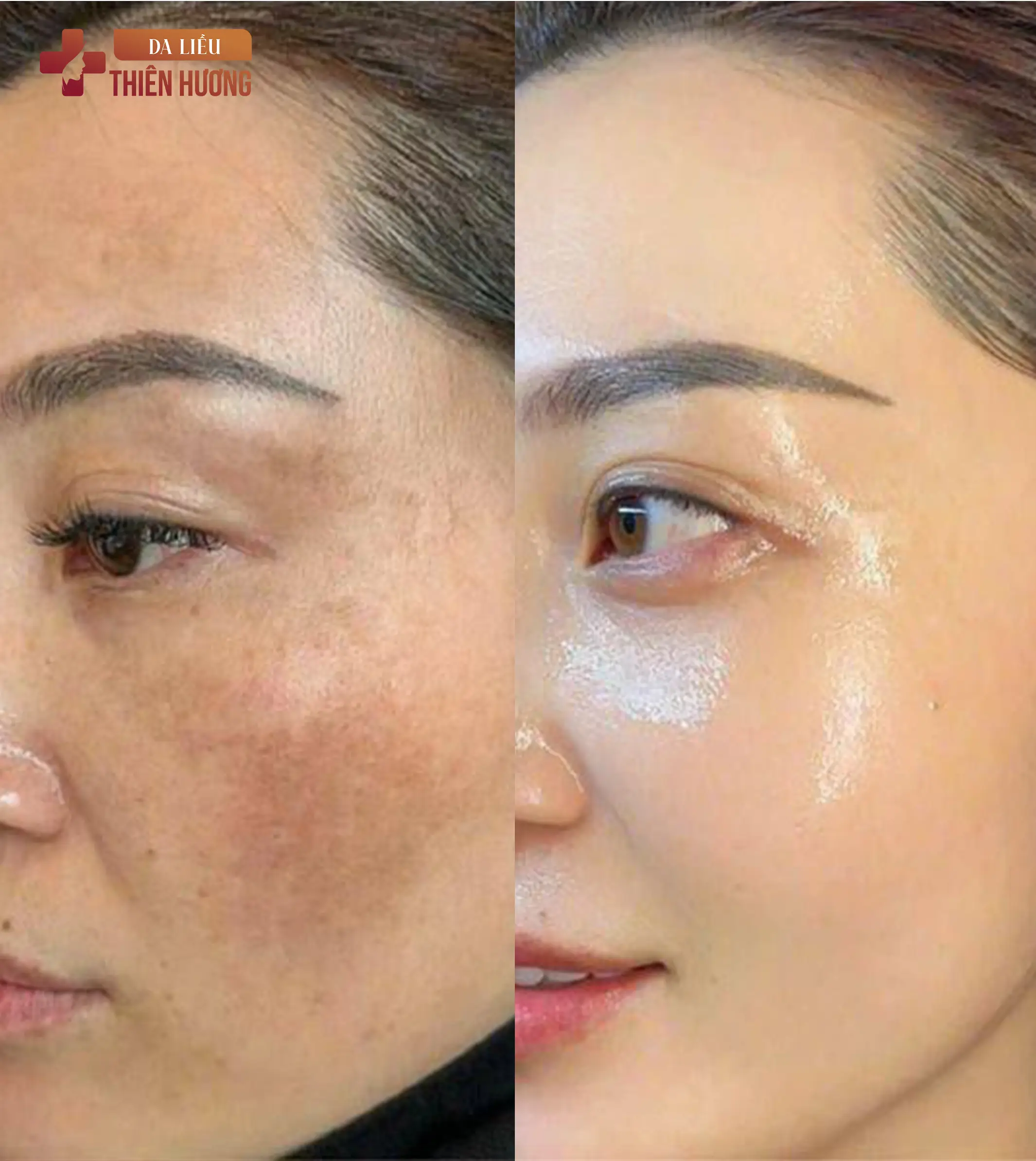 Nám Hỗn Hợp Là Gì? Dấu Hiệu Nhận Biết & Cách Điều Trị Dứt Điểm