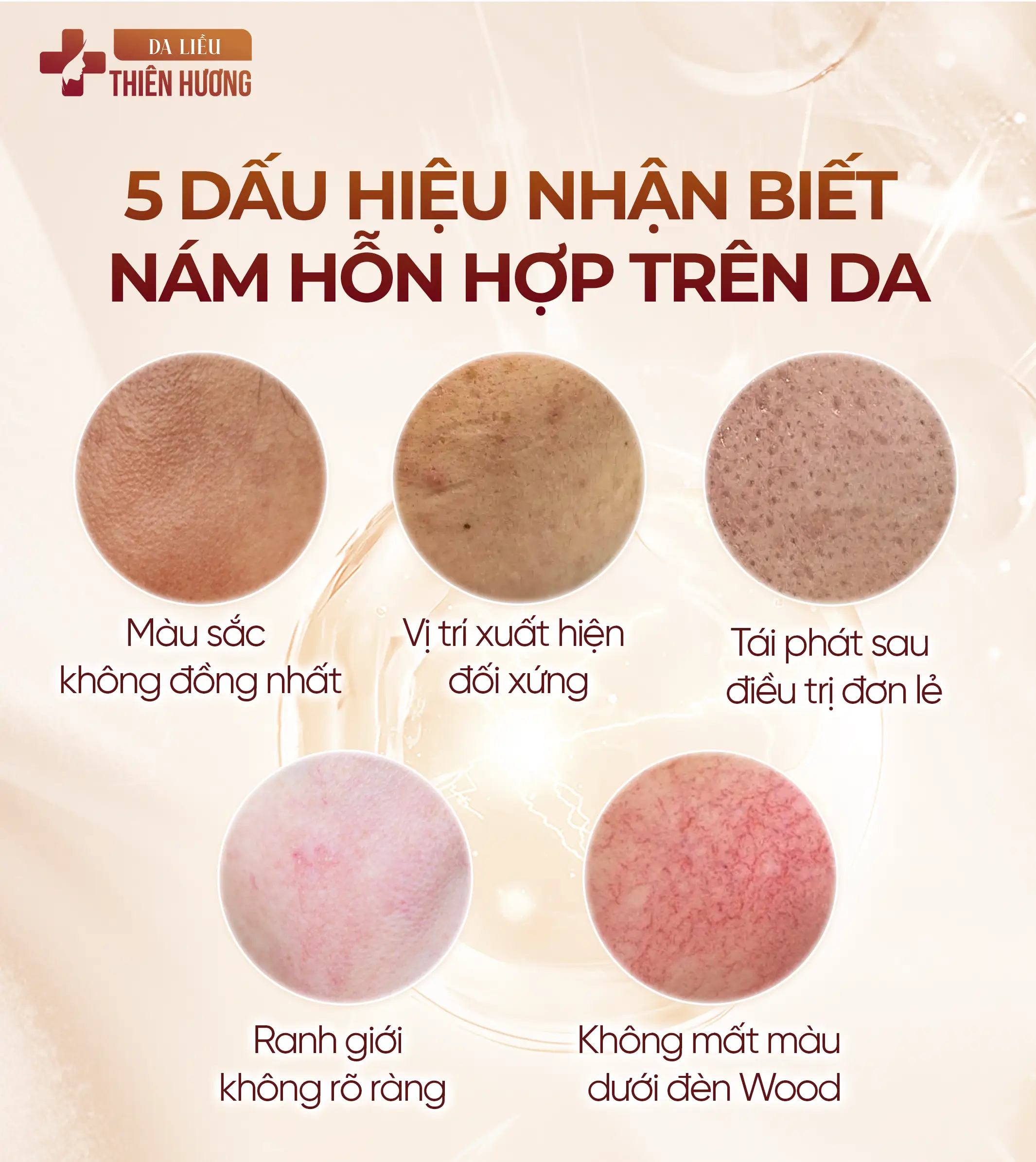 Nám Hỗn Hợp Là Gì? Dấu Hiệu Nhận Biết & Cách Điều Trị Dứt Điểm