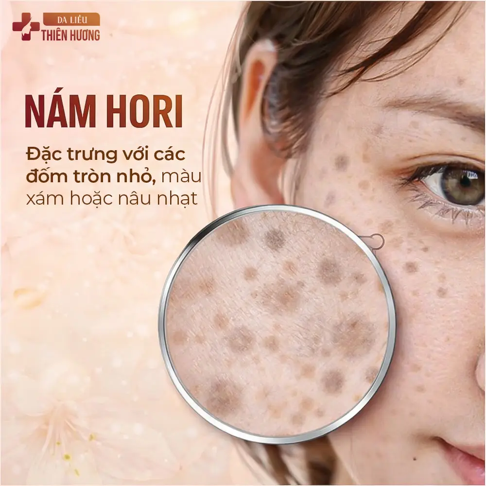 Nám Hori (Bớt Hori): Dấu Hiệu Nhận Biết, Nguyên Nhân & Cách Điều Trị