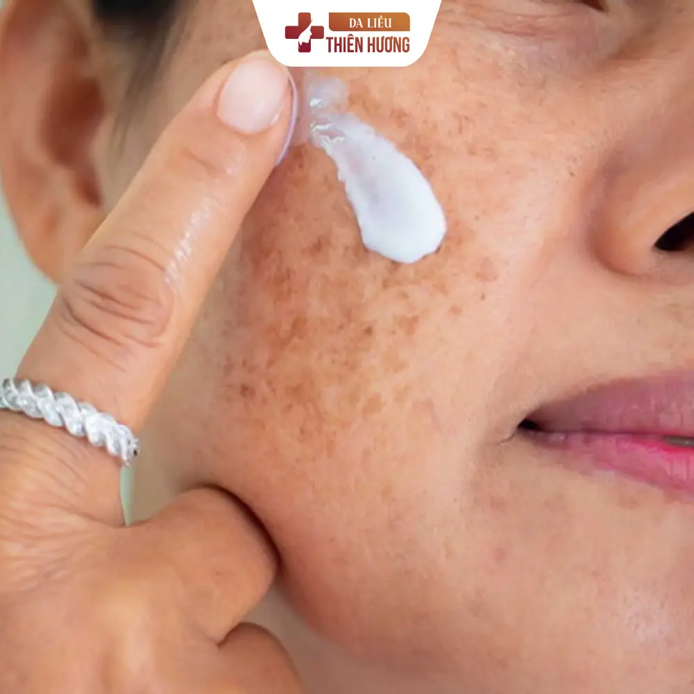 Nám Hori (Bớt Hori): Dấu Hiệu Nhận Biết, Nguyên Nhân & Cách Điều Trị