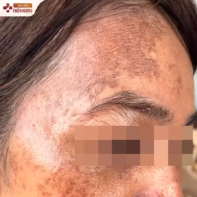 Nám Khói Là Gì? Nguyên Nhân, Dấu Hiệu & Cách Điều Trị