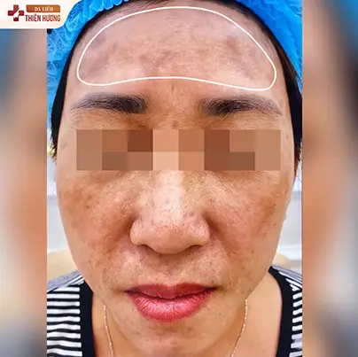 Nám Khói Là Gì? Nguyên Nhân, Dấu Hiệu & Cách Điều Trị