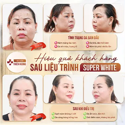 Nám Khói Là Gì? Nguyên Nhân, Dấu Hiệu & Cách Điều Trị