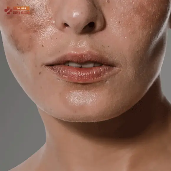 Nám Da Vùng Má: Nguyên Nhân, Phân Loại & Cách Điều Trị Hiệu Quả