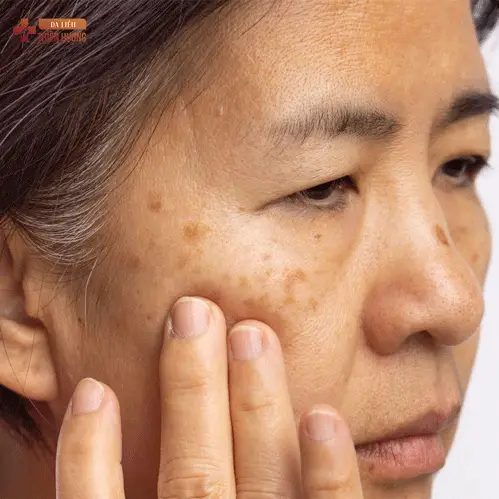 Nám Da Vùng Má: Nguyên Nhân, Phân Loại & Cách Điều Trị Hiệu Quả
