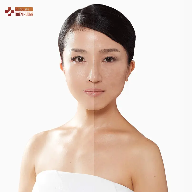 Nám Da Vùng Má: Nguyên Nhân, Phân Loại & Cách Điều Trị Hiệu Quả