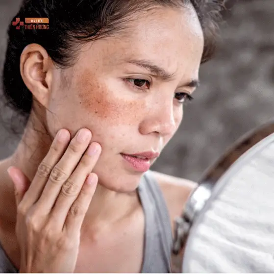 Nám Mảng Là Gì? Nguyên Nhân, Dấu Hiệu Nhận Biết & Cách Điều Trị