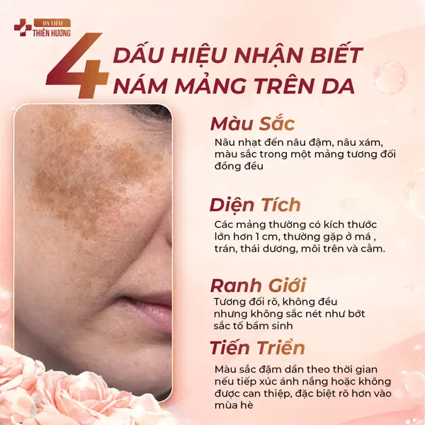 Nám Mảng Là Gì? Nguyên Nhân, Dấu Hiệu Nhận Biết & Cách Điều Trị