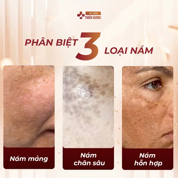 Nám Mảng Là Gì? Nguyên Nhân, Dấu Hiệu Nhận Biết & Cách Điều Trị